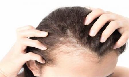 این ۳ ماده خوراکی مقصر ریزش موی شما هستند